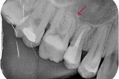 endodontice-osetrenie-zuba-c16_1