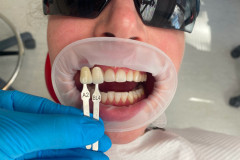 Bielenie-zubov_-povodny-odtien-A2-vysledna-farba-Bl4