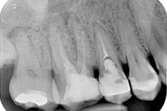 Reendodonticke-osetrenie-zubov-15-a-16-pre-pretrvavavjuce-bolesti-vpravo-hore-1