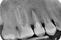 Reendodonticke-osetrenie-zubov-15-a-16-pre-pretrvavavjuce-bolesti-vpravo-hore-2